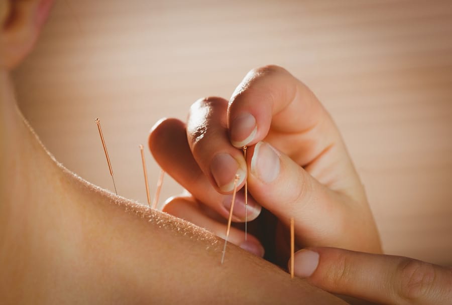 acupuncture-treatment