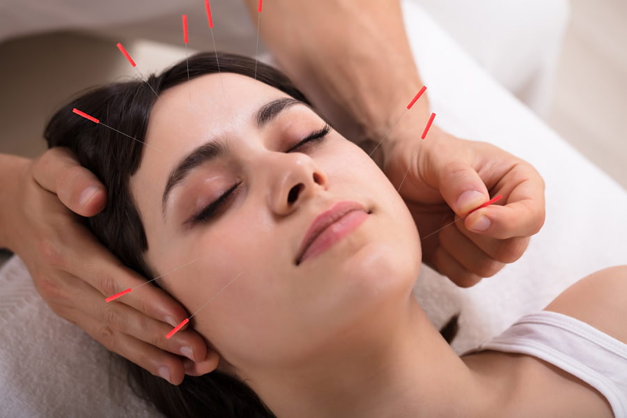 Cosmetic acupuncture in surrey treatments