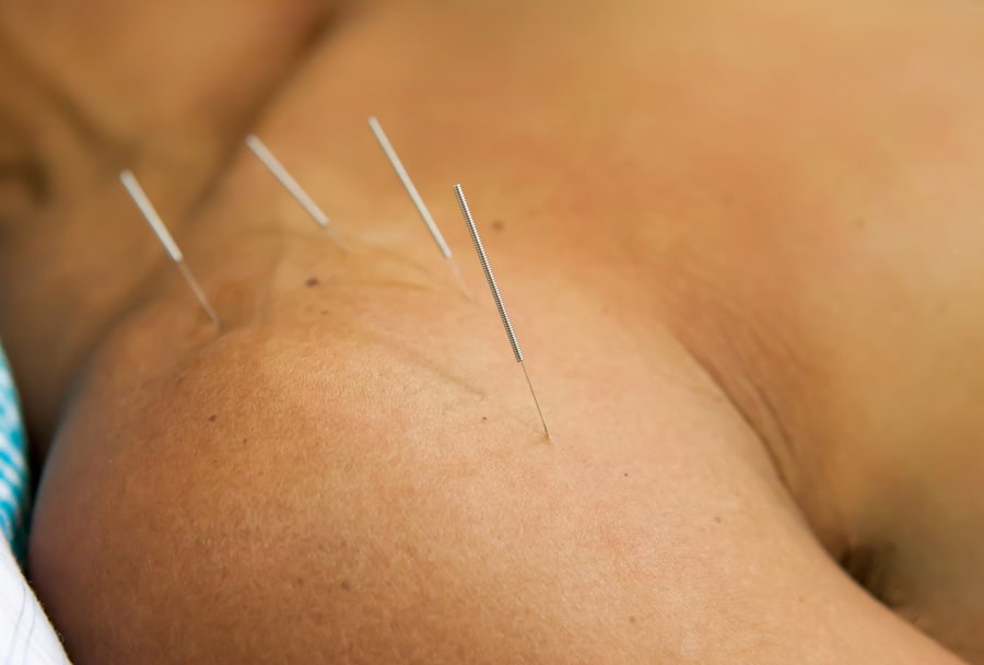 Acupuncture treatment in Surrey